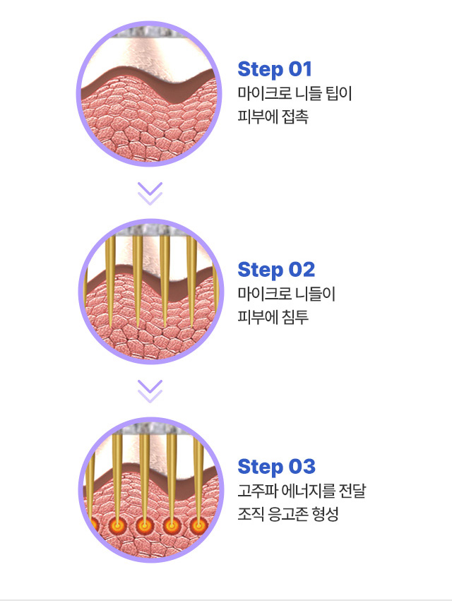 마이크로 니들 팁이 피부에 접촉 - 마이크로 니들이 피부에 침투 - 고주파 에너지를 전달 조직 응고존 형성