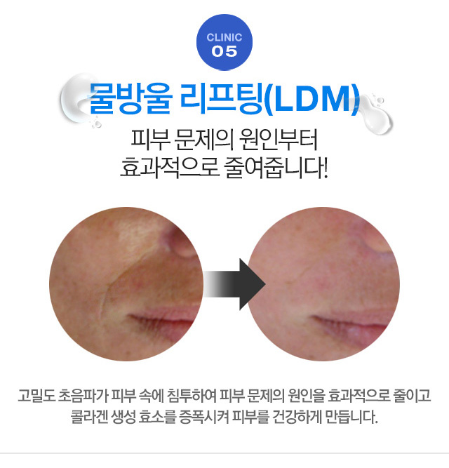 물방울 리프팅 피부 문제의 원인부터 효과적으로 줄여줍니다!