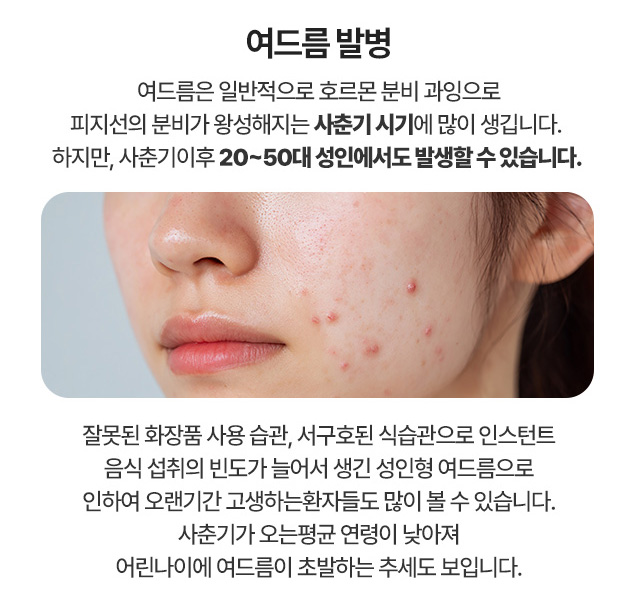 여드름발병 여드름은 일반적으로 호르몬 분비 과잉으로 피지선의 분비가 왕성해지는 사춘기 시기에 많이 생깁니다.